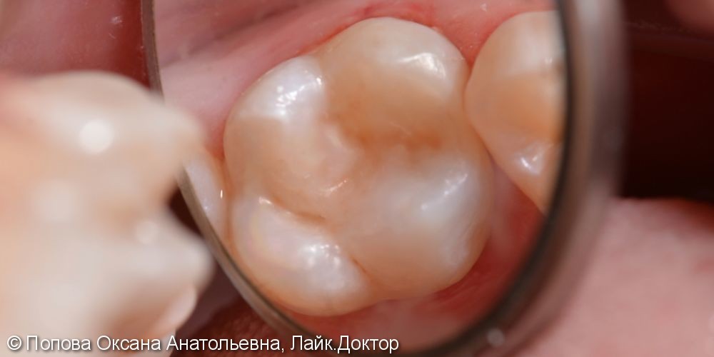 Лечение глубокого кариеса жевательного 2.6 зуба - фото №3