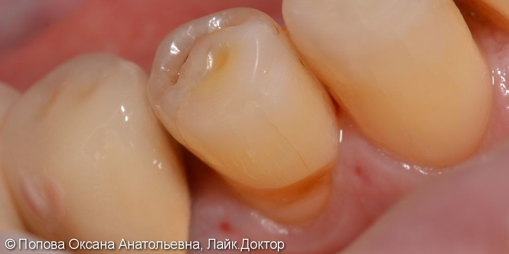 Лечение клиновидного дефекта 4.4 зуба - фото №1