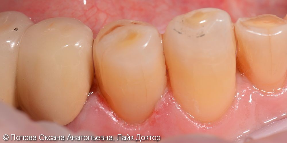 Лечение клиновидного дефекта 4.4 зуба - фото №2