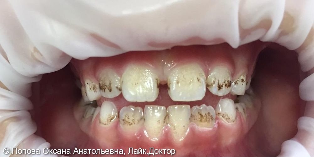 отложения на зубах К 03.6 по МКБ-10 - фото №1
