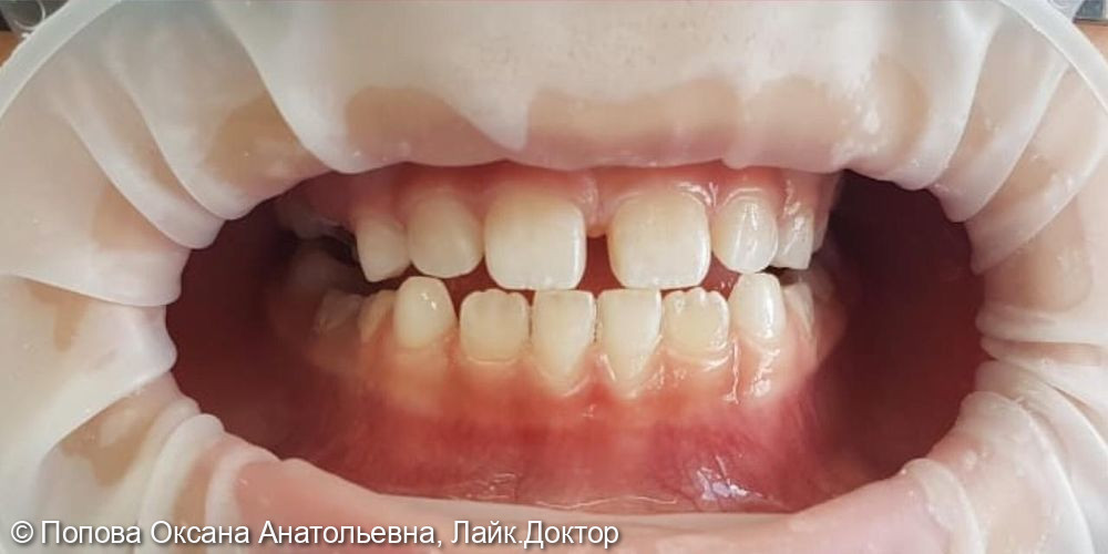 отложения на зубах К 03.6 по МКБ-10 - фото №2