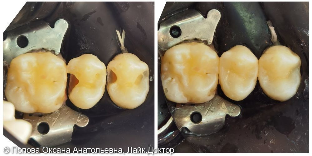 Лечение глубокого кариеса 2.4, 2.5 зуба - фото №2