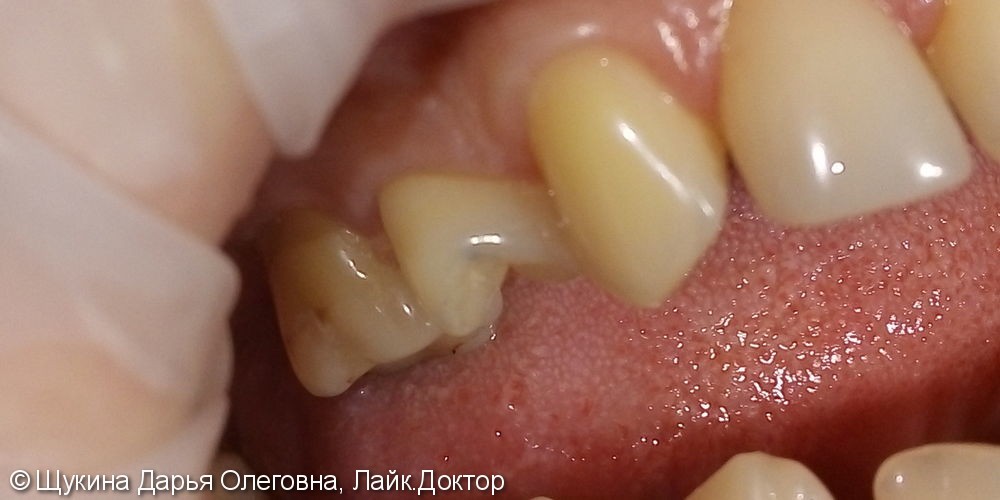 Лечение глубокого кариеса на жевательной поверхности 1.4 зуб - фото №1