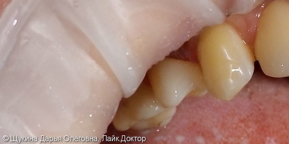 Лечение глубокого кариеса на жевательной поверхности 1.4 зуб - фото №2