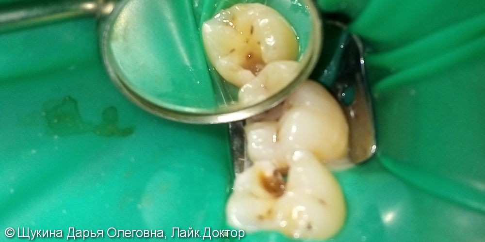 Лечение глубокого кариеса зуб 3.6 - фото №1