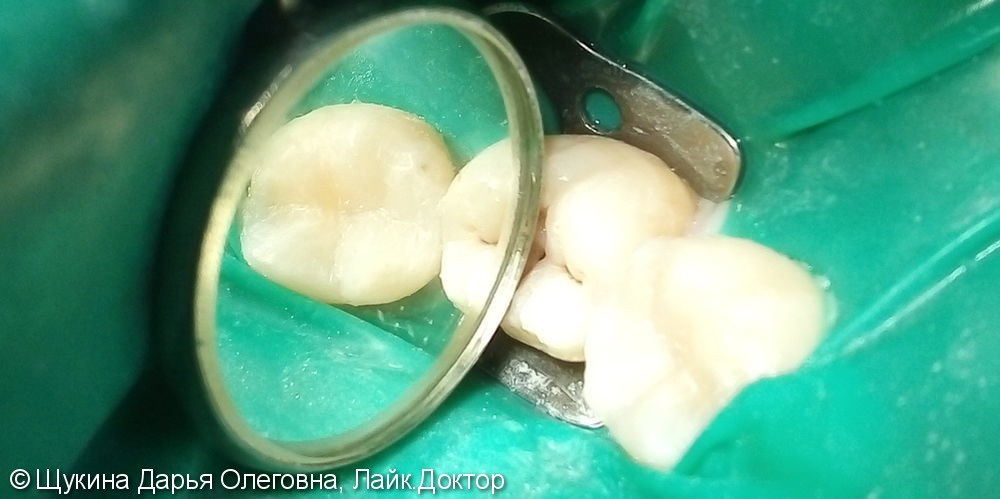 Лечение глубокого кариеса зуб 3.6 - фото №2