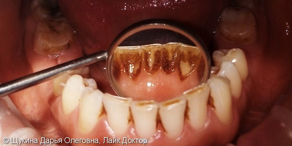 Зубные отложения верхней и нижней челюстей - фото №1