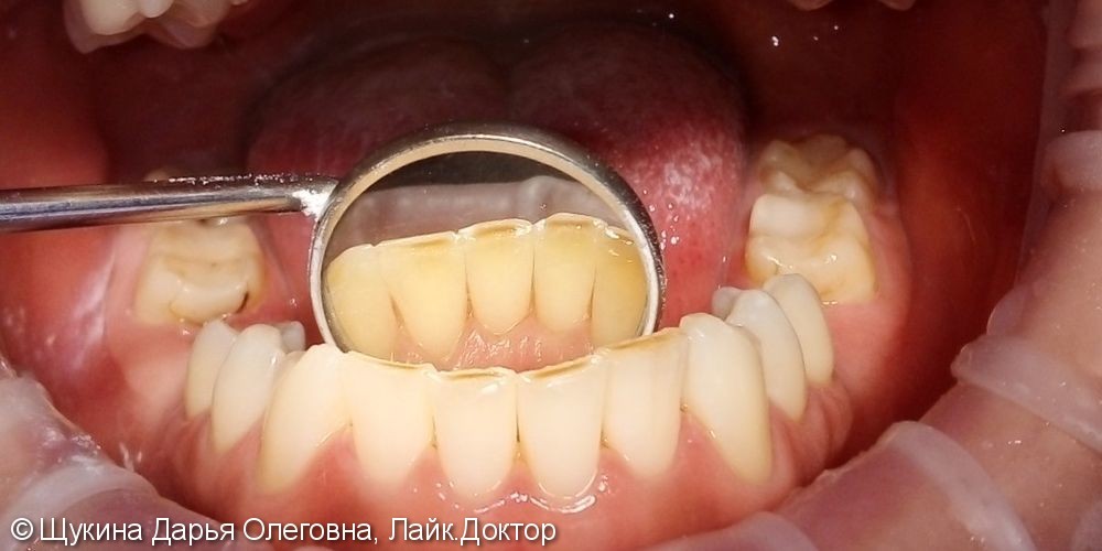 Зубные отложения верхней и нижней челюстей - фото №2
