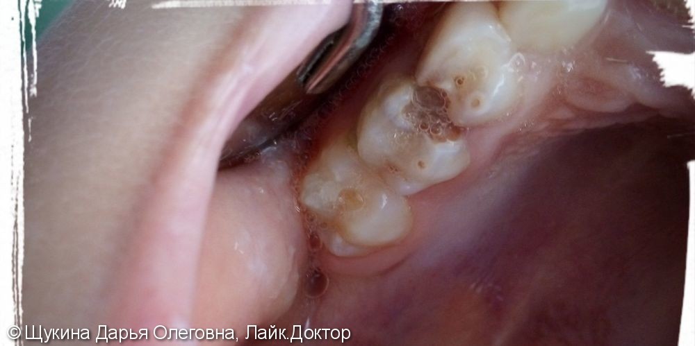Лечение глубокого кариеса 5.4, 5.5 зубов - фото №1