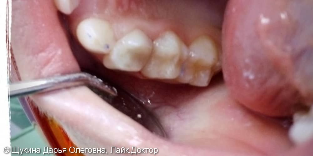 Лечение глубокого кариеса 5.4, 5.5 зубов - фото №2