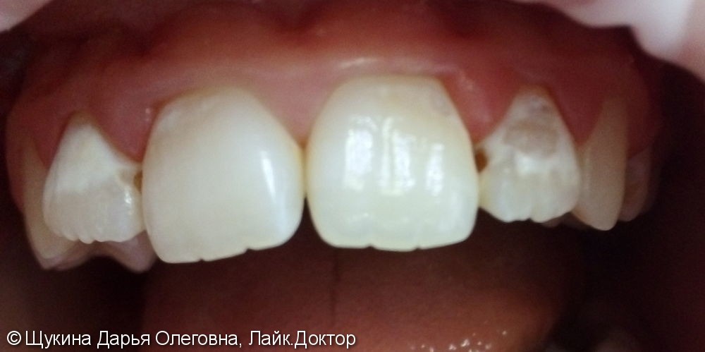 Лечение гипоплазия эмали 1.2 1.1 2.1 2.2 зубов осложненная кариесом - фото №1