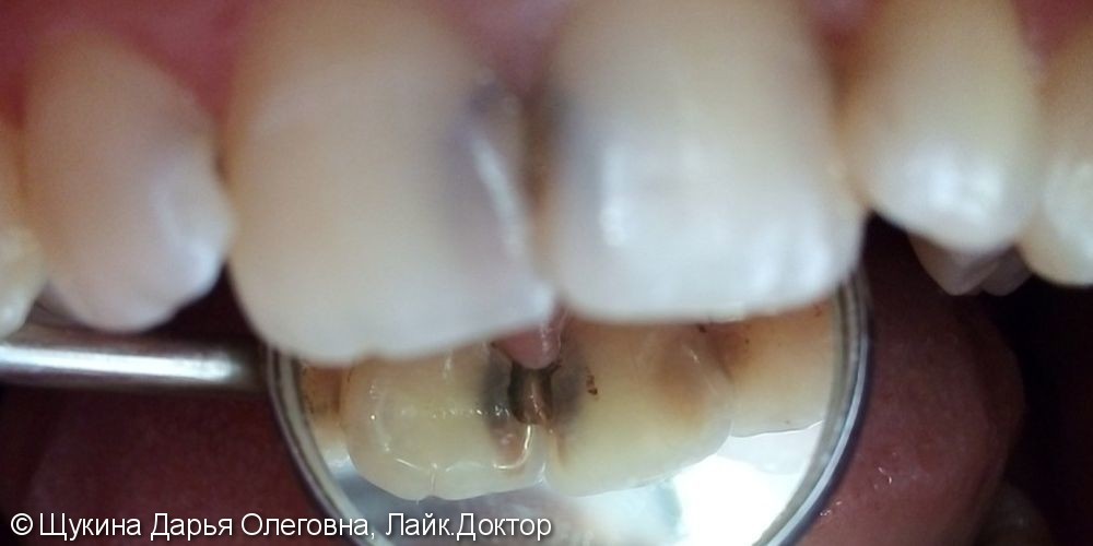 Лечение кариеса 1.1 2.1 зубов - фото №1