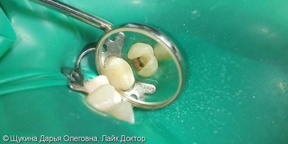 Лечение хронического пульпита зуб 2.4 - фото №1