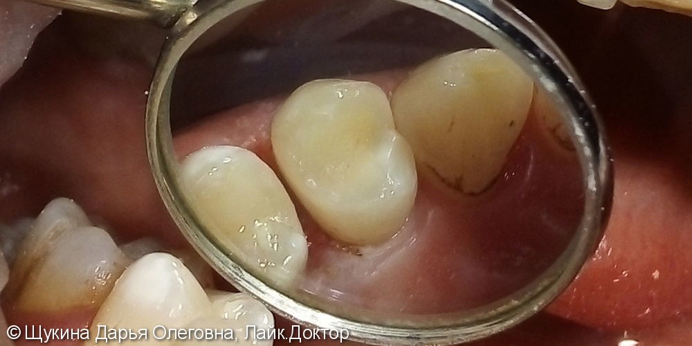 Лечение хронического пульпита зуб 2.4 - фото №3