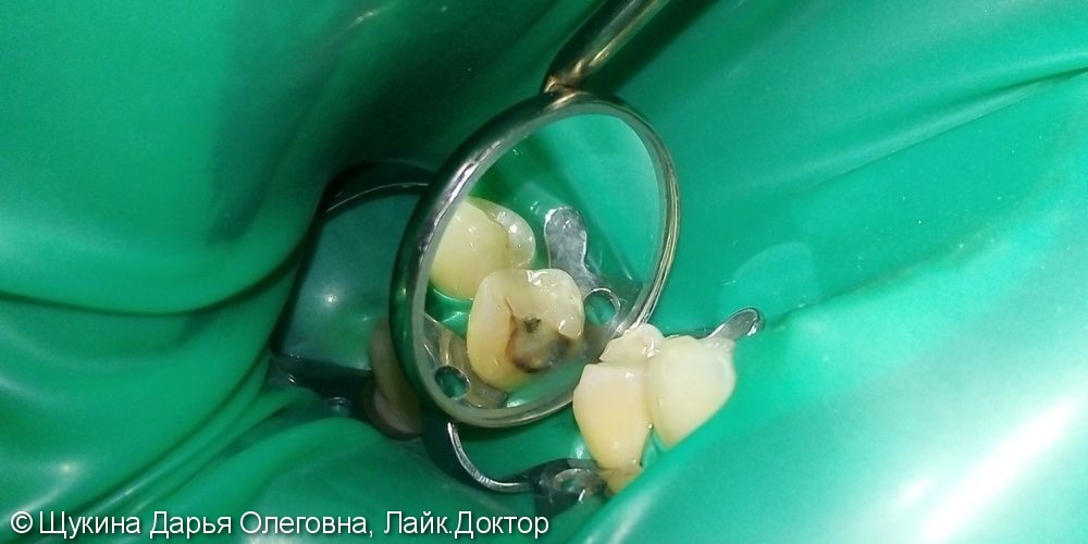 Лечение кариеса 4.5 зуба - фото №1