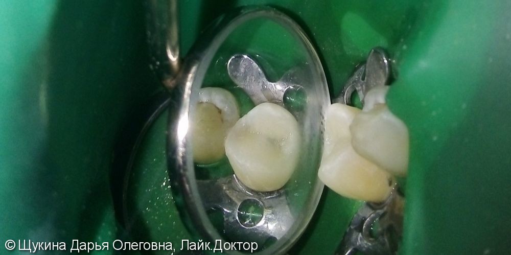 Лечение кариеса 4.5 зуба - фото №2