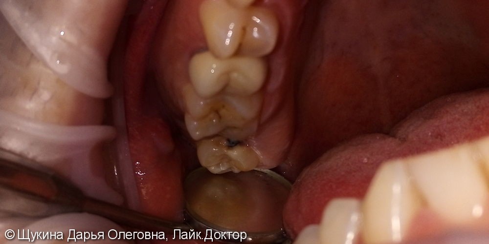 Лечение кариеса жевательного 1.8 зуба - фото №1