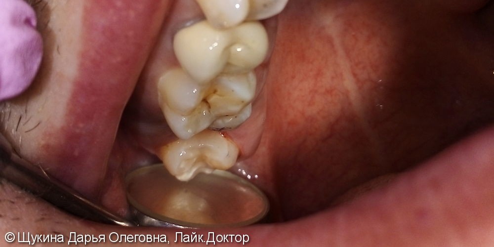 Лечение кариеса жевательного 1.8 зуба - фото №2
