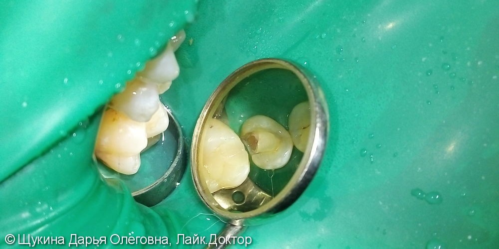 Лечение кариеса 1.5 зуба - фото №1