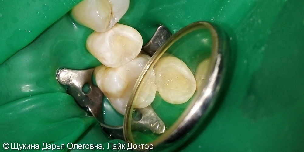 Лечение кариеса 1.5 зуба - фото №2