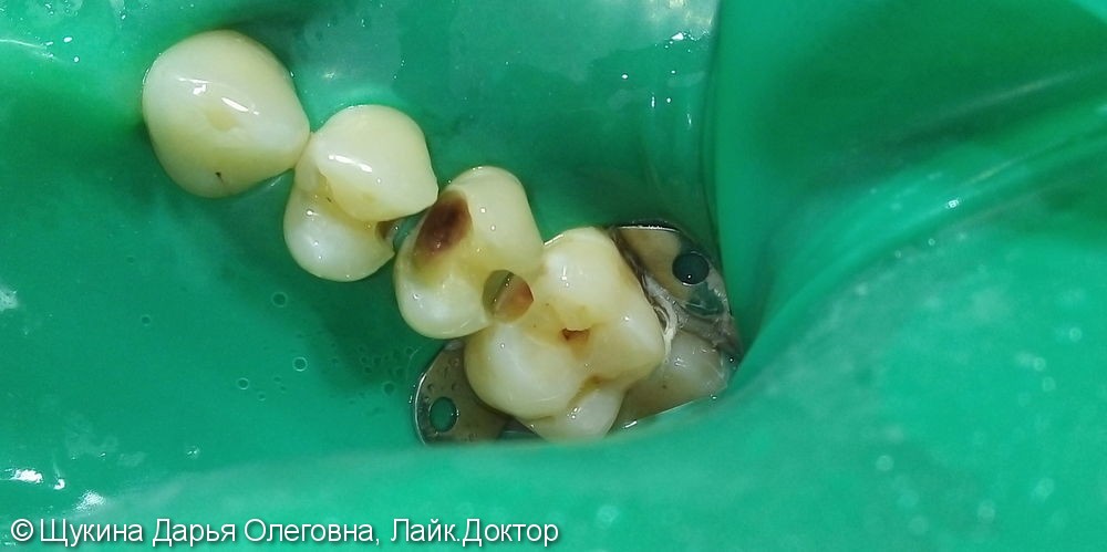 Лечение кариеса 2.4 2.5 2.6 зубов - фото №1