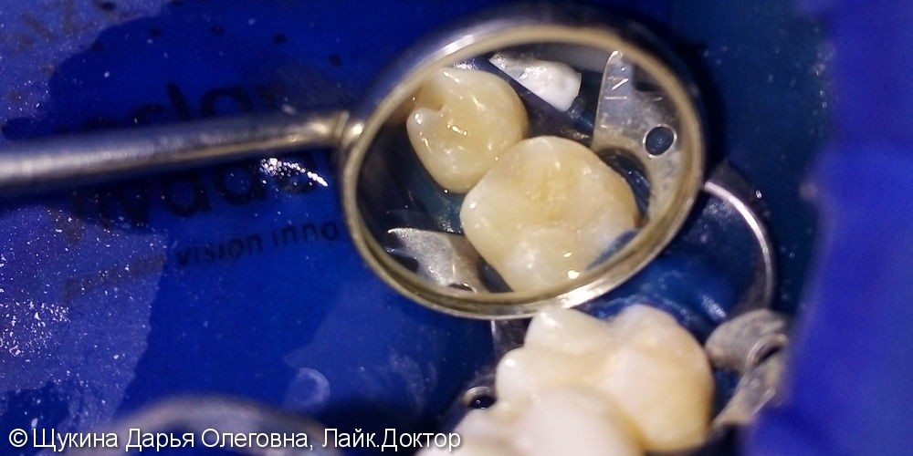 Лечение кариеса жевательного 3.5 3.6 зубов - фото №2
