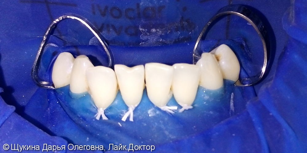 Реставрация фронтальных зубов - фото №1
