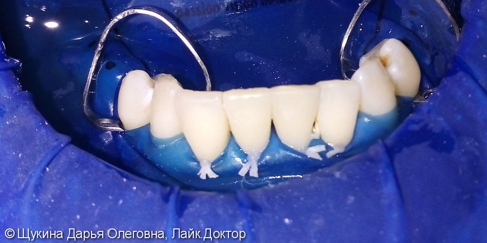 Реставрация фронтальных зубов - фото №2