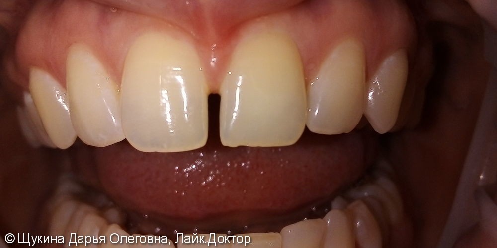 Реставрация фронтальных зубов, закрытие щели ( диастемы) между 1.1 2.1 зубами - фото №1