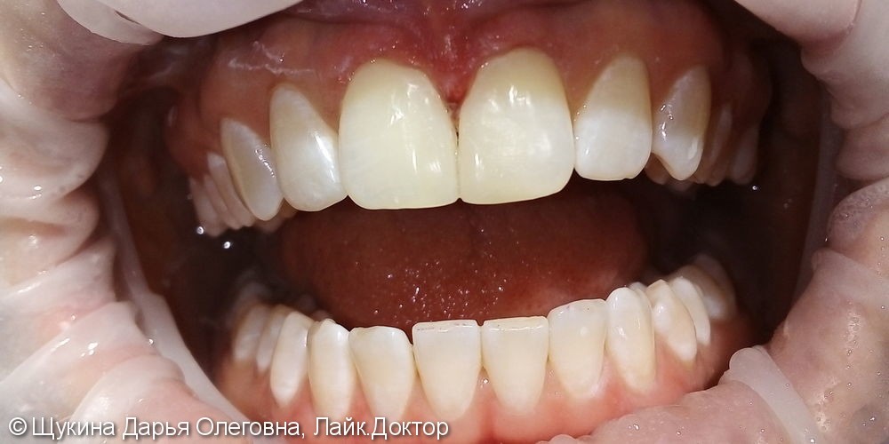 Реставрация фронтальных зубов, закрытие щели ( диастемы) между 1.1 2.1 зубами - фото №2