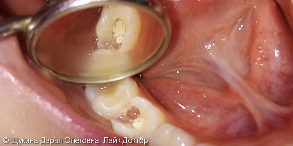 Лечение пульпита молочного жевательного зуба - фото №1