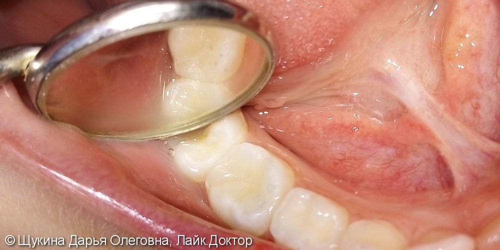 Лечение пульпита молочного жевательного зуба - фото №2