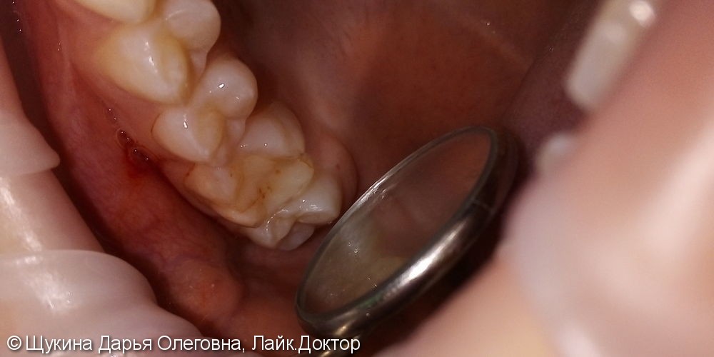 Лечение кариеса жевательного 16 зуба - фото №1