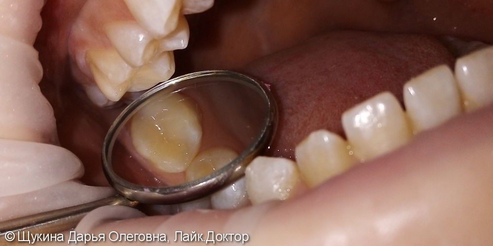 Лечение кариеса жевательного 16 зуба - фото №2