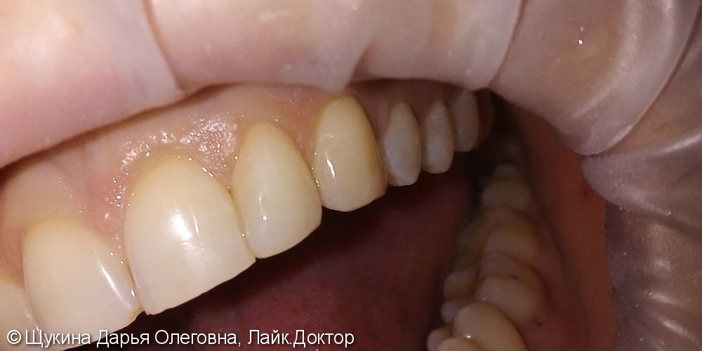 Лечение кариеса 23 зуба - фото №2
