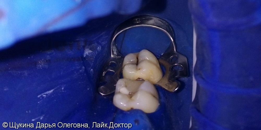 Лечение кариеса жевательных зубов - фото №1