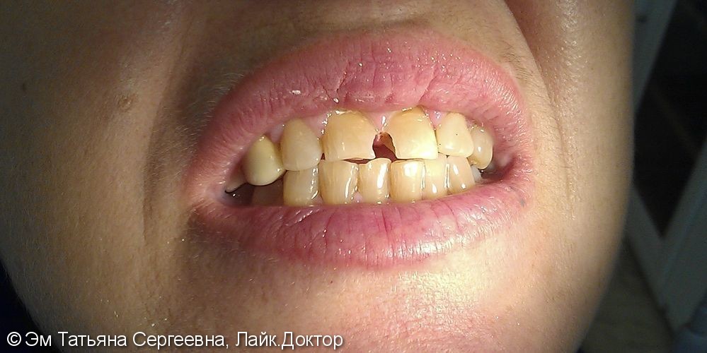 Лечение среднего кариеса 12,21 зубов - фото №1
