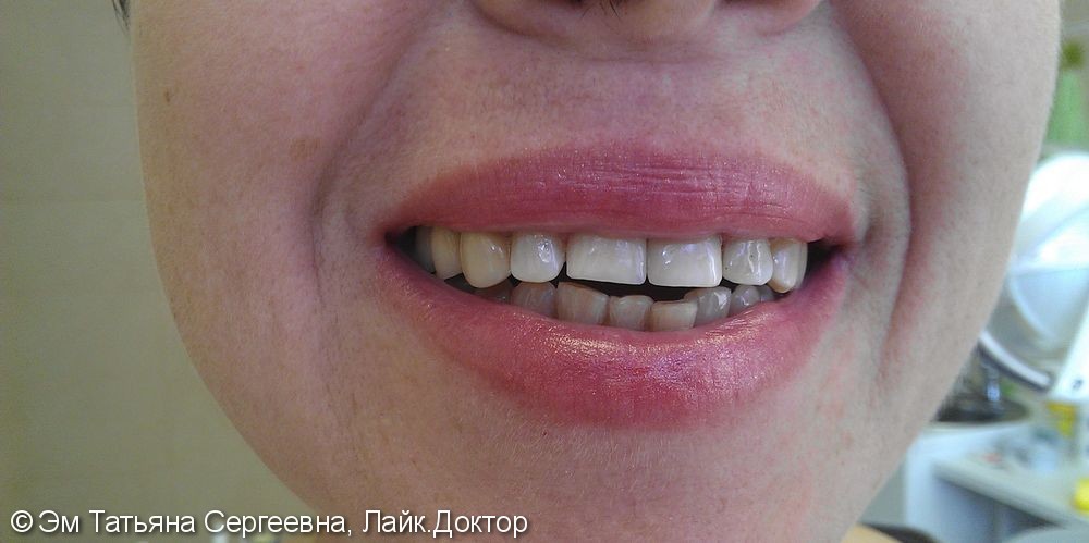 Лечение среднего кариеса 12,21 зубов - фото №3