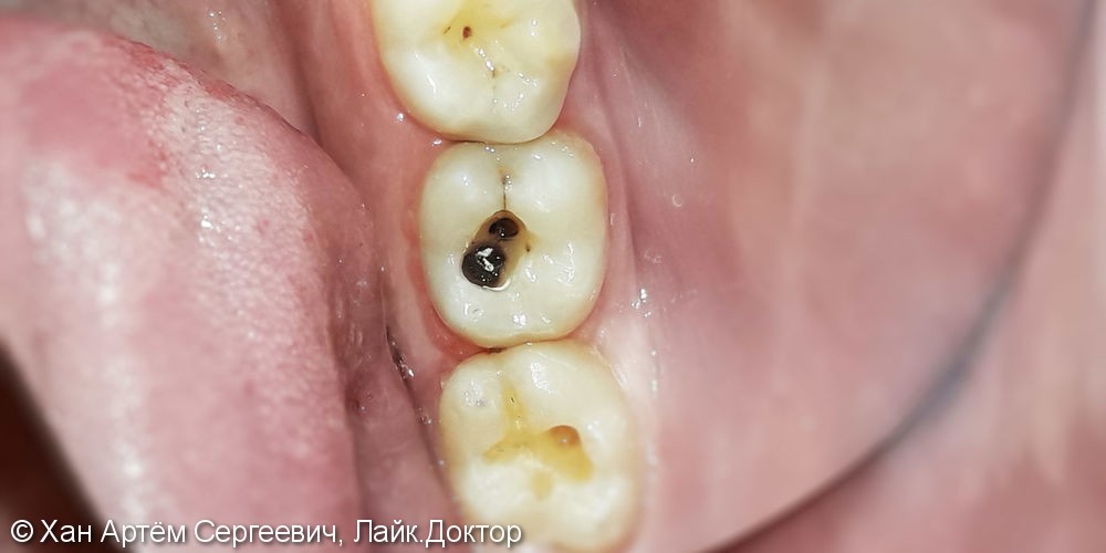 Лечение и реставрация зубов №37/№38 фотополимером Ceram-X - фото №1
