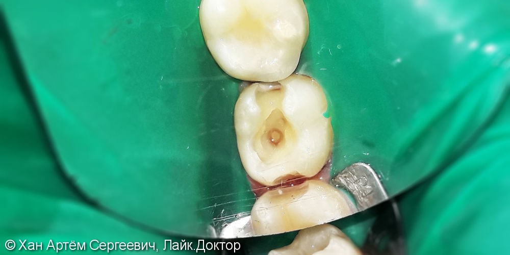 Лечение и реставрация зубов №37/№38 фотополимером Ceram-X - фото №2