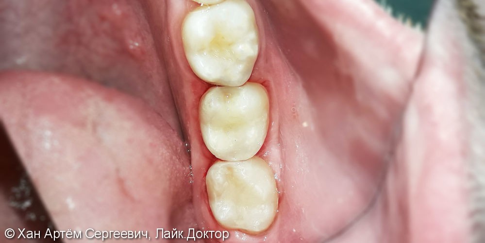 Лечение и реставрация зубов №37/№38 фотополимером Ceram-X - фото №3