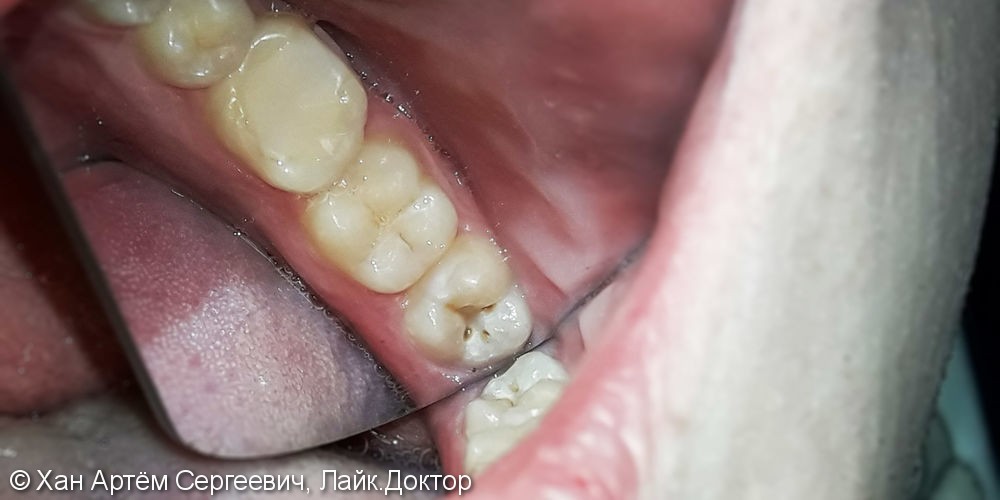 Лечение и реставрация зуба №38 фотополимером Ceram-X - фото №1