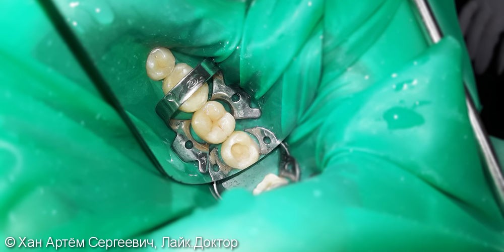Лечение и реставрация зуба №38 фотополимером Ceram-X - фото №2