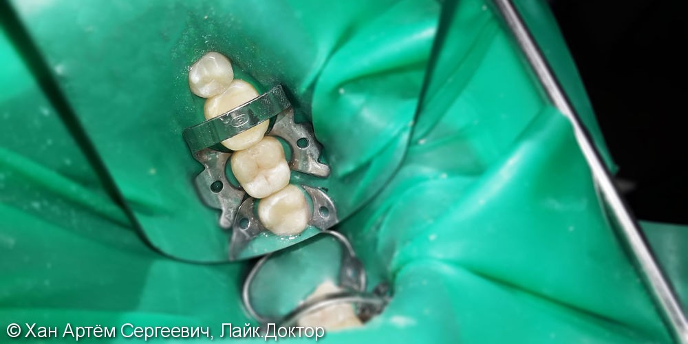 Лечение и реставрация зуба №38 фотополимером Ceram-X - фото №3