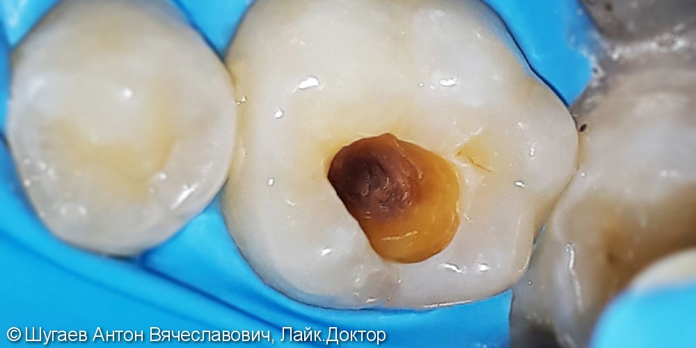 Лечение и реставрация зуба №36 фотополимером Ceram-X - фото №1
