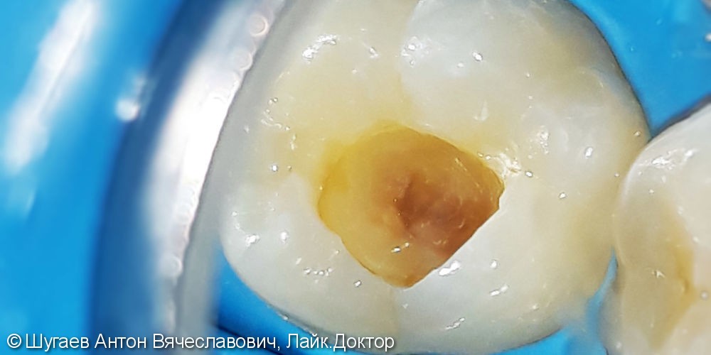 Лечение и реставрация зуба №36 фотополимером Ceram-X - фото №2