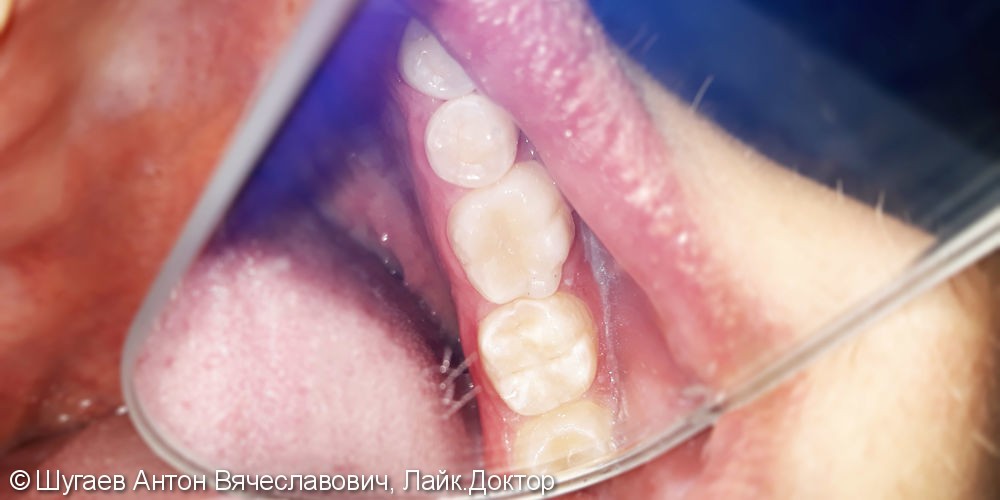 Лечение и реставрация зуба №36 фотополимером Ceram-X - фото №3