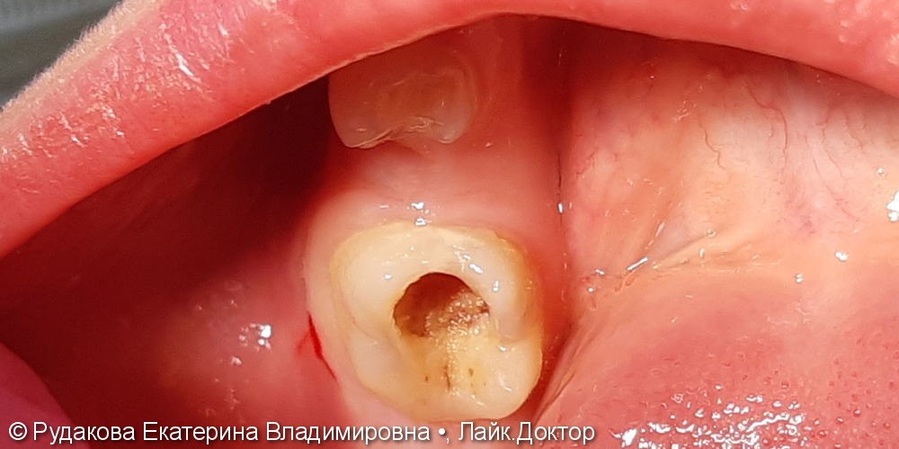 Лечение глубокого кариеса 36 зуба - фото №1