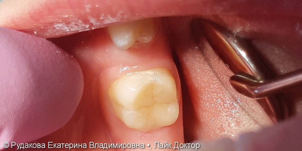 Лечение глубокого кариеса 36 зуба - фото №2