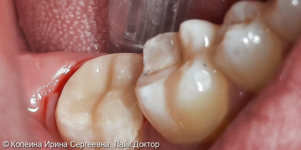 Лечение зуба 4.7 - фото №2